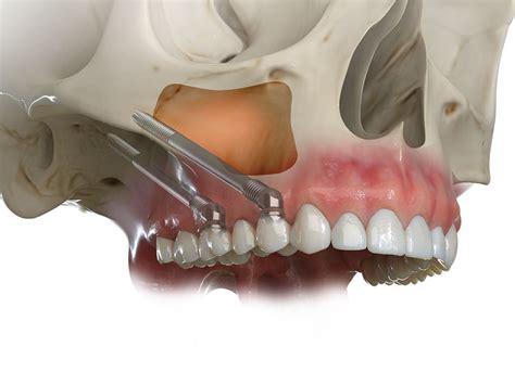 Zygomatic Implants A Groundbreaking Solution For Complex Dental