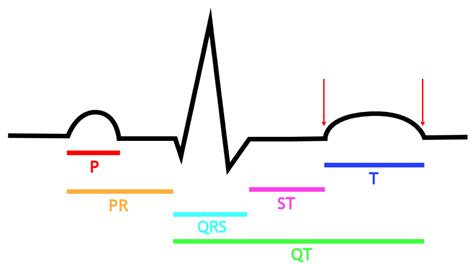 t-wave - Cardiac Sciences Manitoba