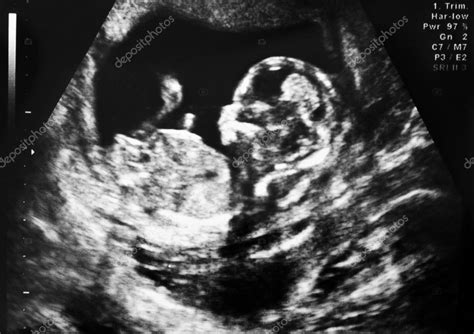 Ultrasound of fetus — Stock Photo © kubais #5232749