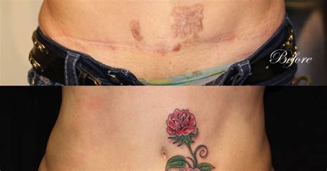 Another Tummy Tuck Scar Cover Up I Like The Different Designs Tummy Scar Cover Up