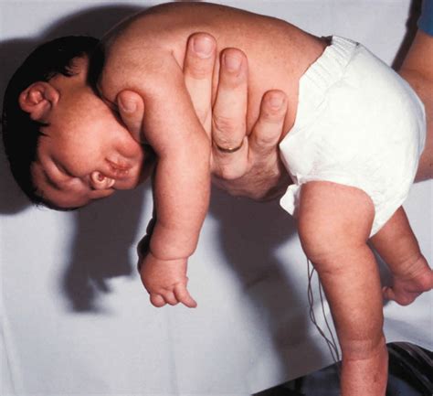 Floppy baby syndrome causes, signs, symptoms, diagnosis & treatment