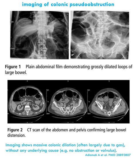 Sindrome De Ogilvie 1