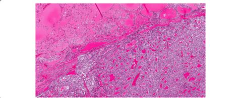 Struma Ovarii With Papillary Thyroid Carcinoma Hande 4x Download