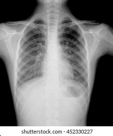 Chest Xray Vascular Access Permacath Insertion Stock Photo 1593331306 ...