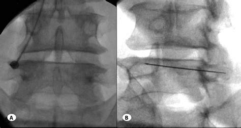 Figure 1 From Comparison Of Effectiveness Of Facet Joint Injection And