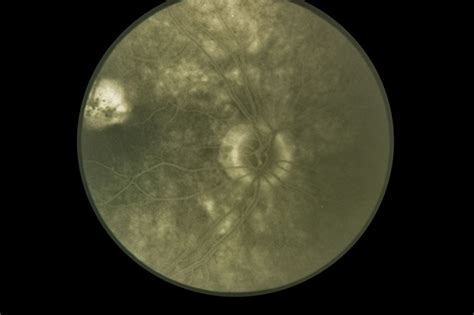 Presumed Ocular Histoplasmosis Syndrome Retina Image Bank