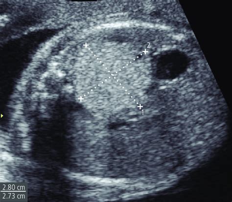 Transverse Sonogram Of The Fetal Chest Shows An Echogenic Lung Mass Of Download Scientific