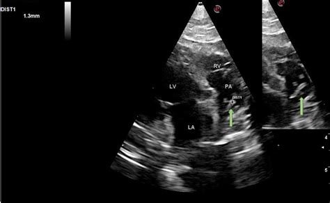 Echocardiographic Image With Slight Modification In The Left