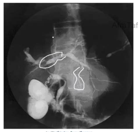 5 Biliary Disease Gallstone Disorder Hyperbilirubinemia And Gallstone