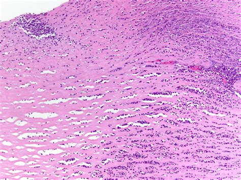 Pathology Outlines Acanthamoeba Keratitis