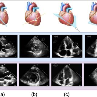 Echocardiograms From 4 Different Views Of The Heart A Parasternal