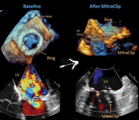 Successful MitraClip Procedure For Severe Mitral Regurgitation After