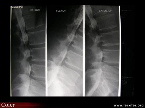 Canal Lombaire R Tr Ci Saccoradiculographie R Tr Cissement Du Canal
