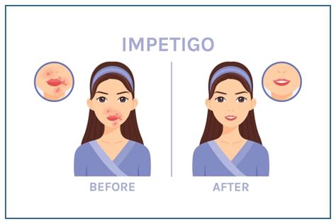 Impétigo Symptômes causes diagnostic et traitement