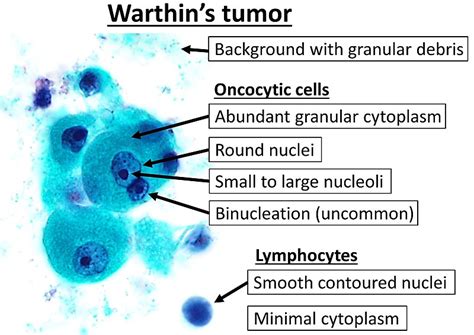 What is the Difference Between Pleomorphic Adenoma and Warthin Tumor ...