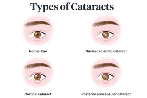 Causes Of Cataracts Ausmed