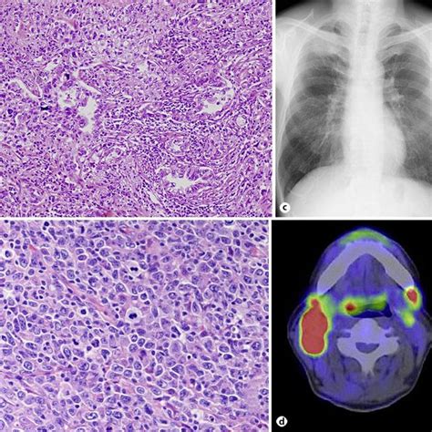 Pathological And Imaging Findings In Case 2 A Surgically Resected