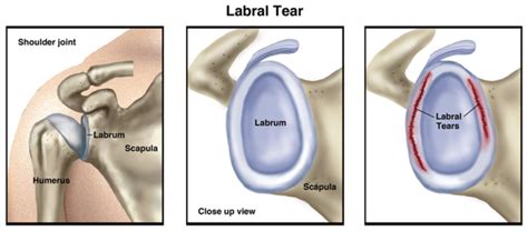 Labrum Injury