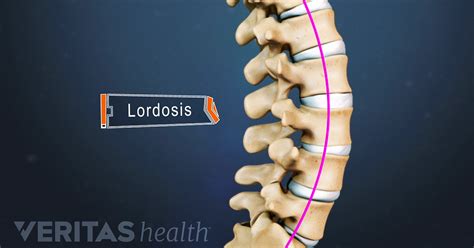 Lordosis Definition Back Pain And Neck Pain Medical Glossary