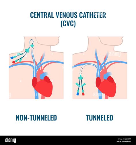 Central Venous Catheter Diagram