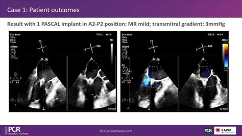 Advancing Valve Repair Mastering Diverse Mitral And Tricuspid