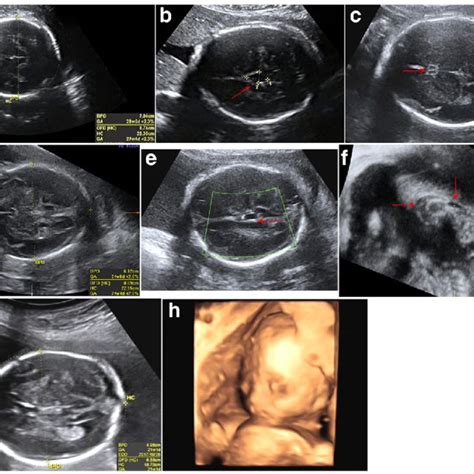 Bpd In Ultrasound Means In Hindi - adrenalinewoman