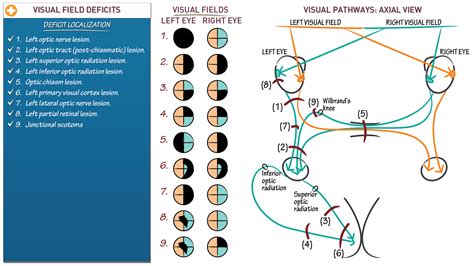 Visual Field Deficit Stroke