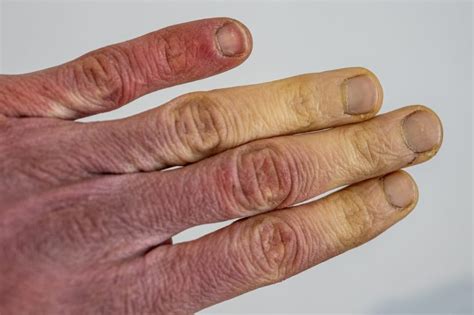 Qualifying For A 100 Raynaud S Syndrome Va Rating