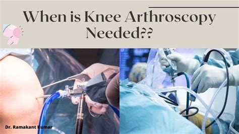 When Is Knee Arthroscopy Needed Knee Arthroscopy Recovery Time