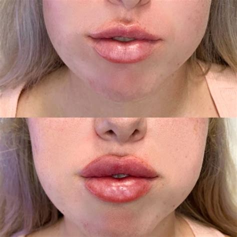 Lip Filler Before And After Lip Fillers For Beautiful Lips