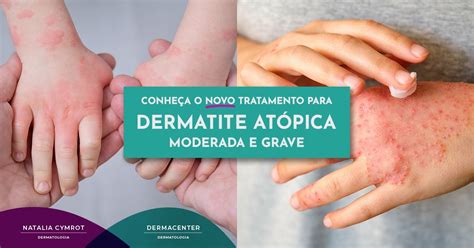 Conhe A O Novo Tratamento Para Dermatite At Pica Moderada E Grave