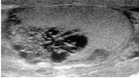 Cystic Lesions And Scrotal Fluid Collections In Adults Ultrasound