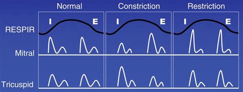 108 best images about Echo Echo on Pinterest | Heart disease, Aortic stenosis and Pericardial ...