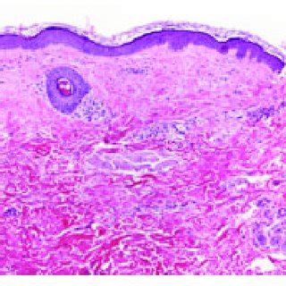 Erythema Annulare Centrifugum Histology