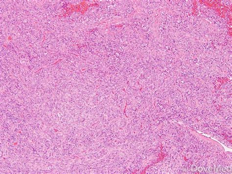 Solitary Fibrous Tumor Of Larynx DoveMed