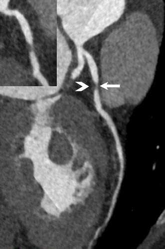 Role Of Coronary CT Angiography In Spontaneous Coronary Artery