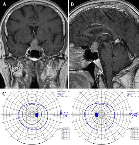 The Outcomes Of Conservatively Observed Asymptomatic Nonfunctioning