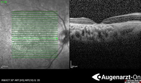 Morbus Stargardt Fundus Flavimaculatus Atlas Der Augenheilkunde