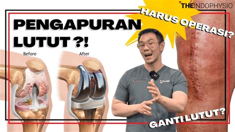 Apakah Pengapuran Harus Operasi Ganti Lutut Youtube