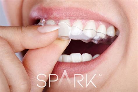 Noul Aparat Dentar Invizibil SPARK Crystal Dental Clinic