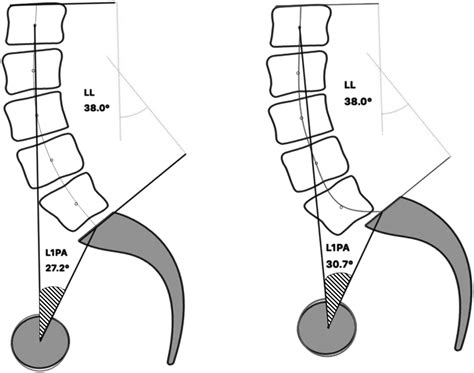 The Shape Of The Fused Spine Is Associated With Acute Proximal