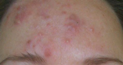 👉 Forehead Acne - Pictures, Causes and Treatment (February 2022)