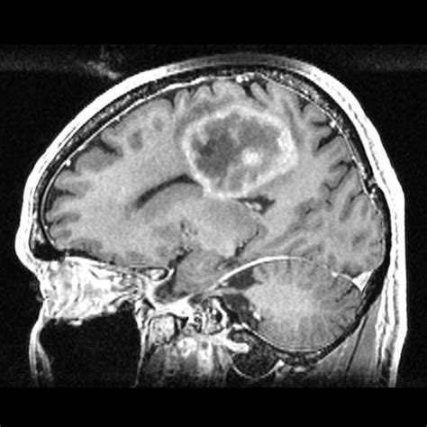 Preoperative MRI showing a high-grade cingulate gyrus glioma on the... | Download Scientific Diagram