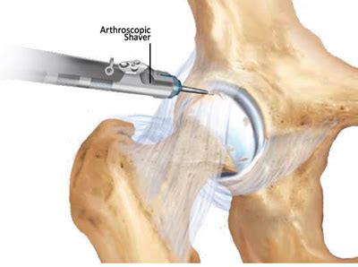 New Treatments For Arthroscopic Hip Surgery Provide Faster Recoveries