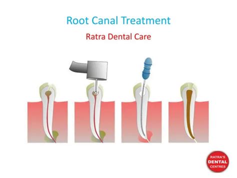 Ppt Tips To Follow After Root Canal Treatment Powerpoint Presentation