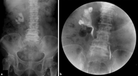 A Kub X Ray Visualized A Large Right Staghorn Stone B Open I