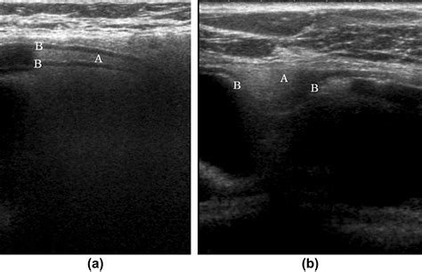 The Sonographic Appearances Of Breast Implant Rupture Clinical Radiology