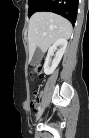 Scar endometriosis | Radiology Case | Radiopaedia.org