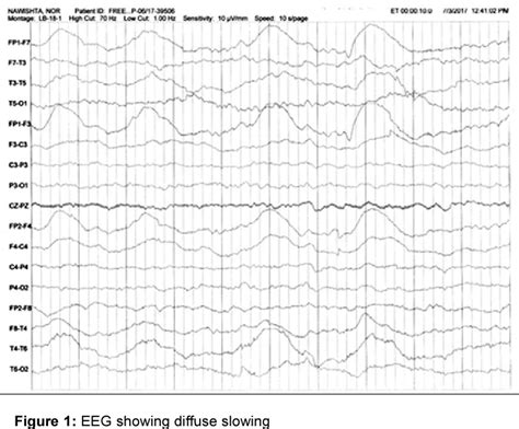 Figure 1 From Anti Nmda Receptor Encephalitis In A Young Girl With Altered Behaviour And