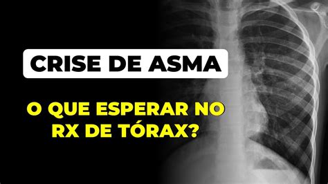 Crise de asma o que esperar no RX de tórax YouTube